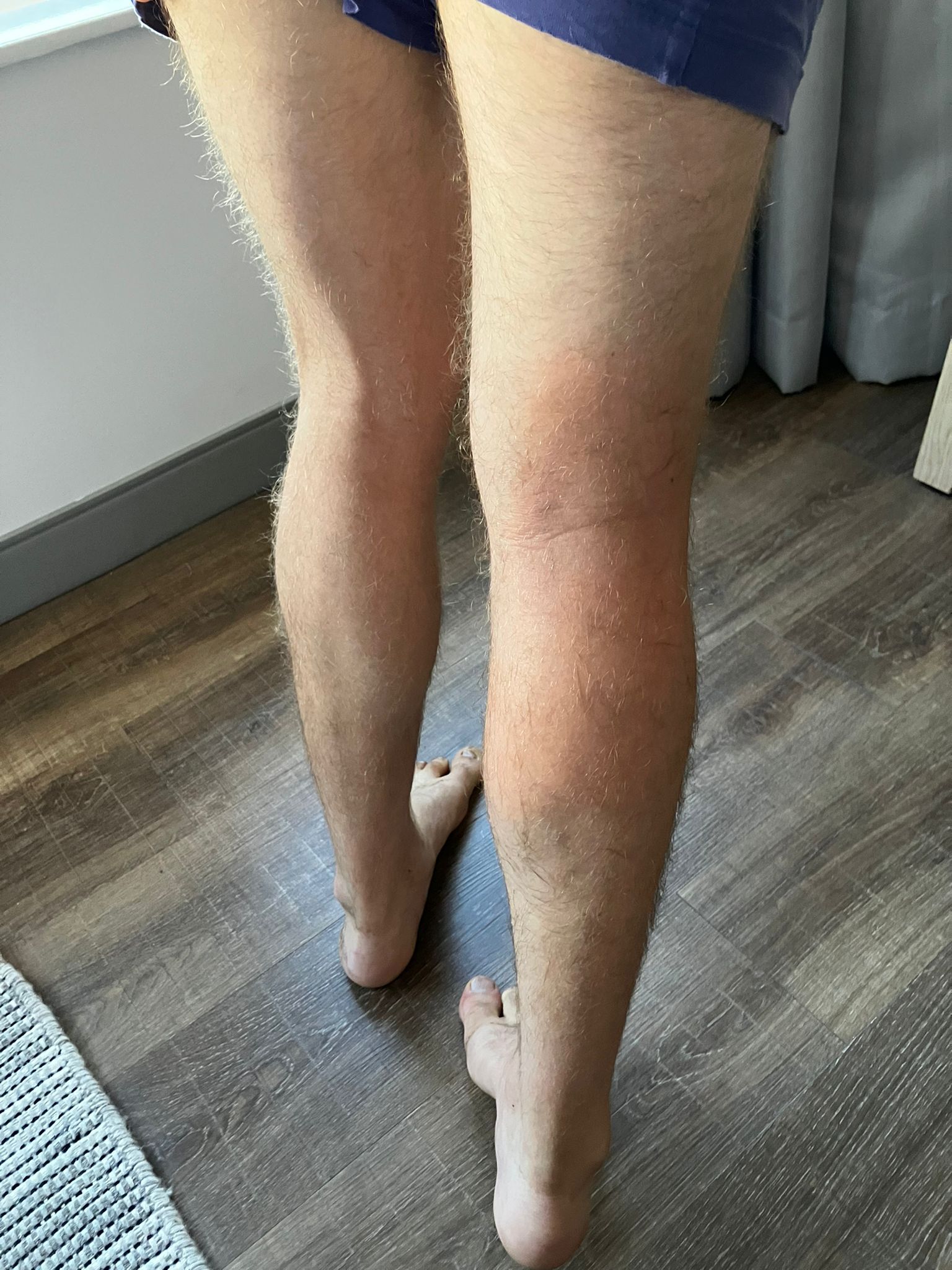 Super swollen calf